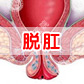 什么是直肠脱垂