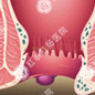 什么是肛乳头瘤?