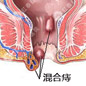 怎么知道自己得了混合痔?