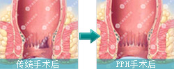 无刀除痔特色疗法