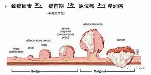 体检查出肠息肉一定要切除！ 95%肠癌由它演变而来