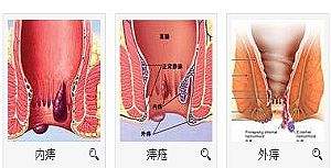 南宁治疗外痔需要多少费用