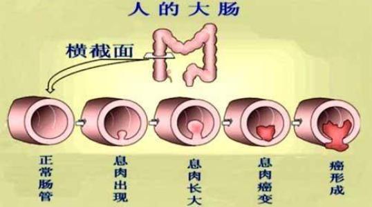 南宁治疗结肠炎要多少费用