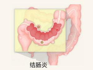 南宁治疗结肠炎哪家医院好