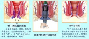 南宁肛肠医院 南宁医博中医肛肠医院 南宁看痔疮的医院 南宁肛瘘医院 南宁肛裂医院 南宁肠炎医院